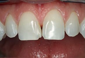 Michael J. Murray, DDS | Dental Bridges, Emergency Treatment and Veneers
